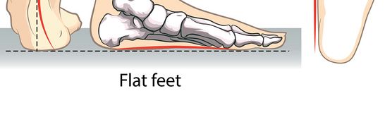 Therapeutic Massage Program Techniques for Treating Pes Planus