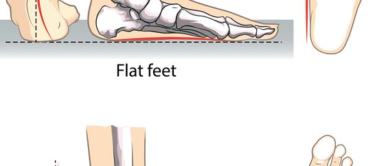 Therapeutic Massage Program Techniques for Treating Pes Planus